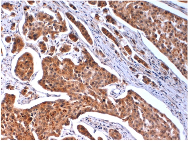 Immunohistochemical staining of FFPE human bladder carcinoma tissue using Histone H2A.x (S140) antibody (Cat. No. X2754P).  Antibody used at 1 µg/ml and visualized using DAB.  Pathologists comments: Positive   cytoplasmic staining on cancer cells.